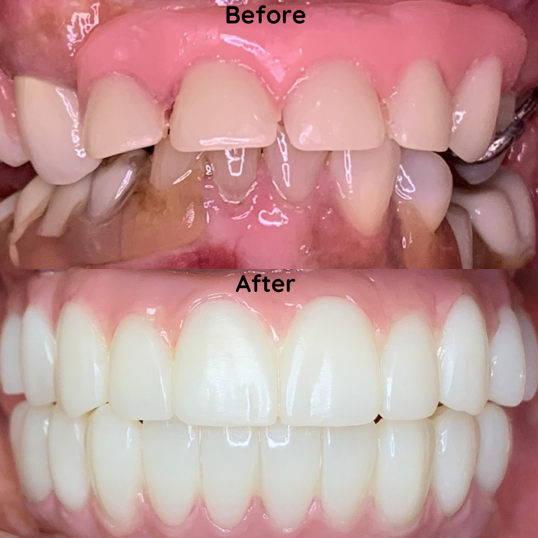 Dentures Before and after denture treatment