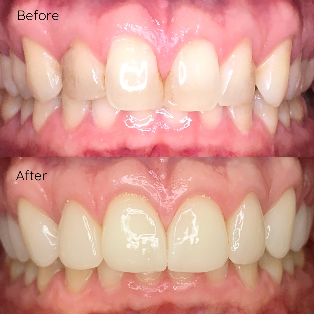 Porcelain Veneers Porcelain Veneers