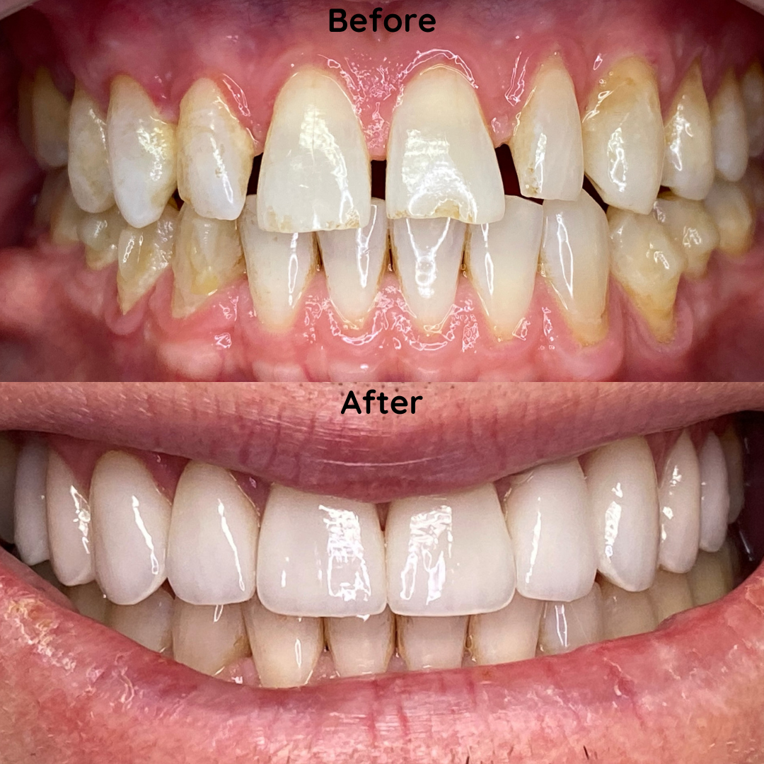 Porcelain Veneers Porcelain Veneers