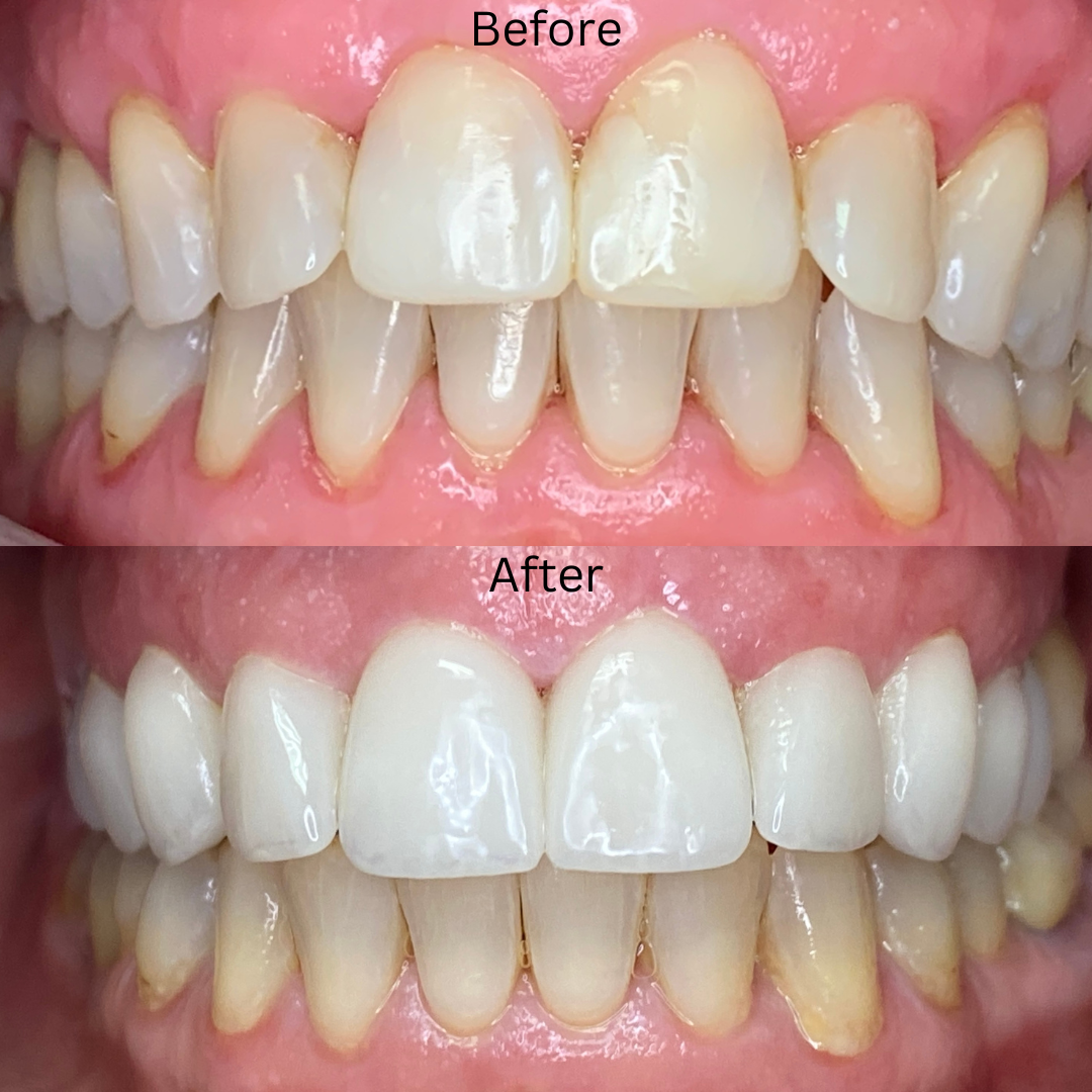 Cosmetic Dentistry Before and After