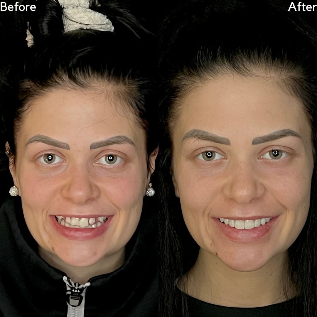 Cosmetic Dentistry Before and After