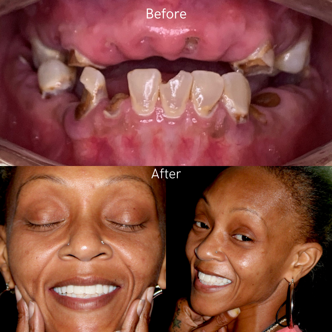 Dentures Digital Smile Design