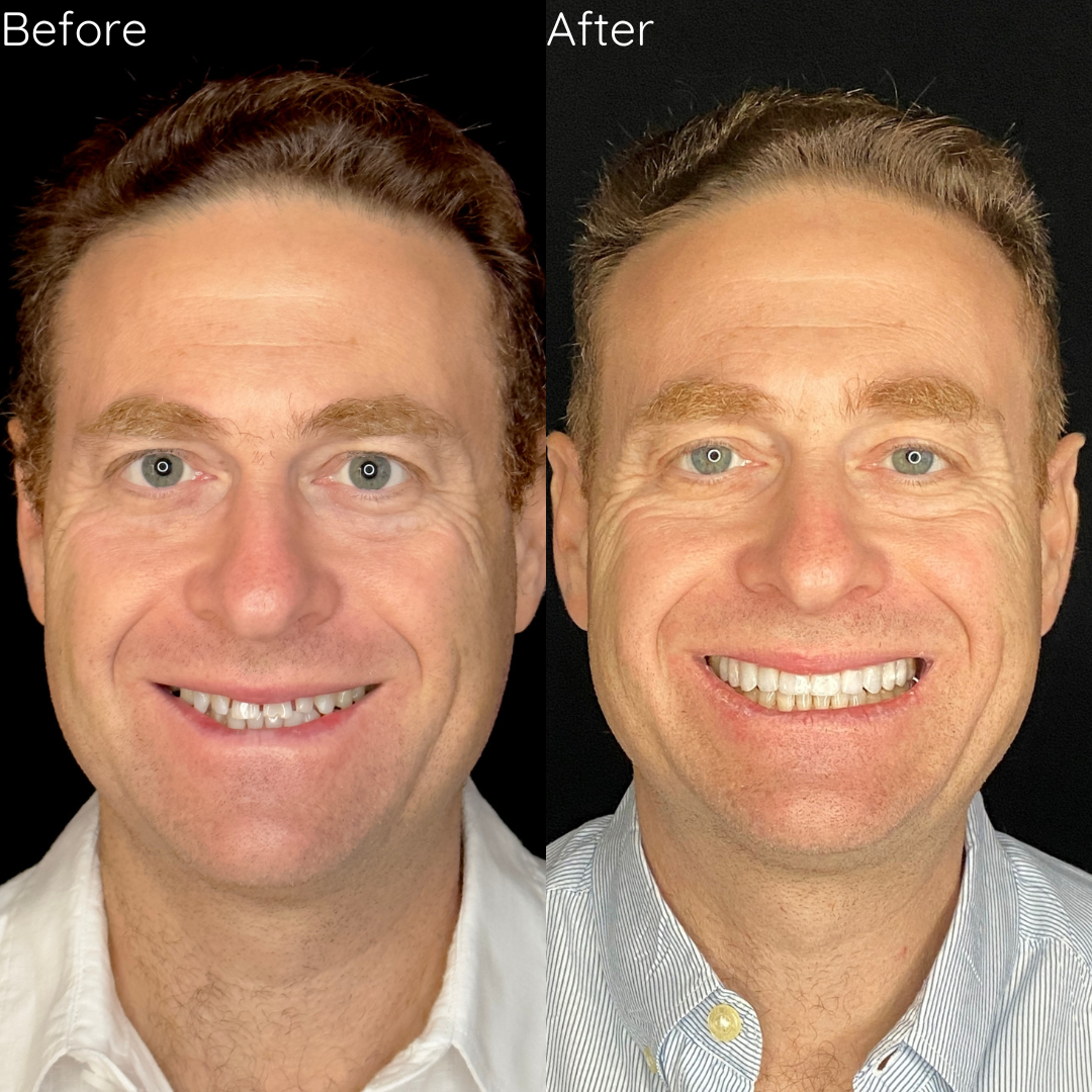 Porcelain Veneers Porcelain Veneers