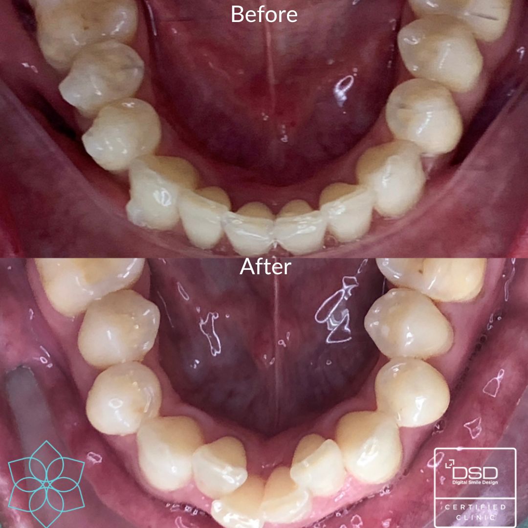Smile Gallery Smile Institute Invisalign Before and After