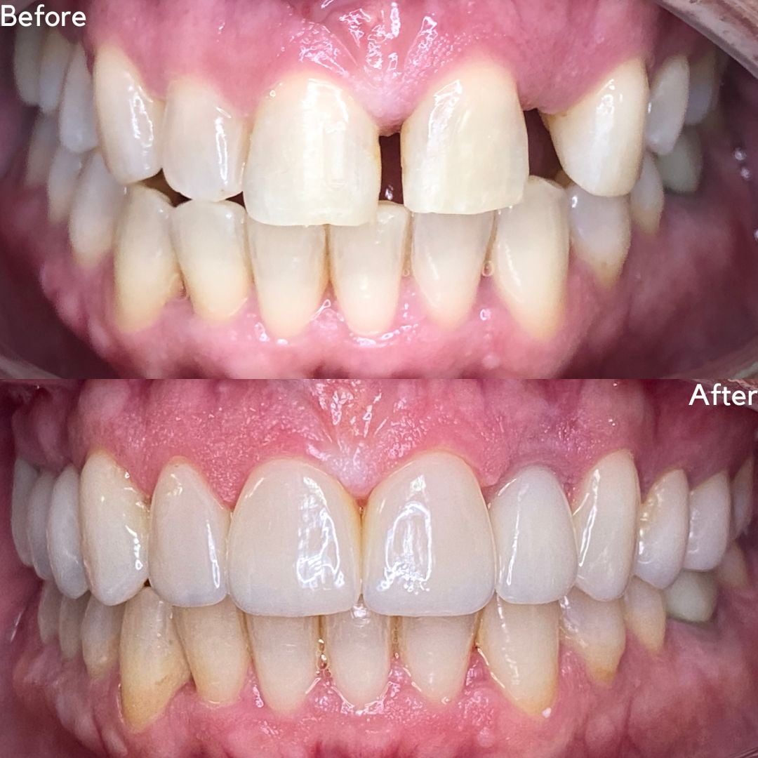 Porcelain Veneers Before And After