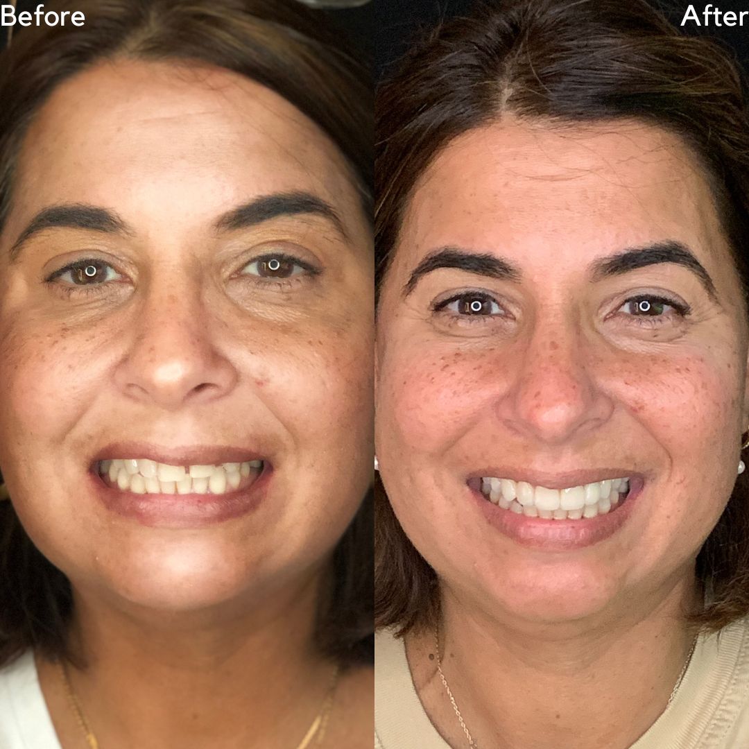 Porcelain Veneers Before And After