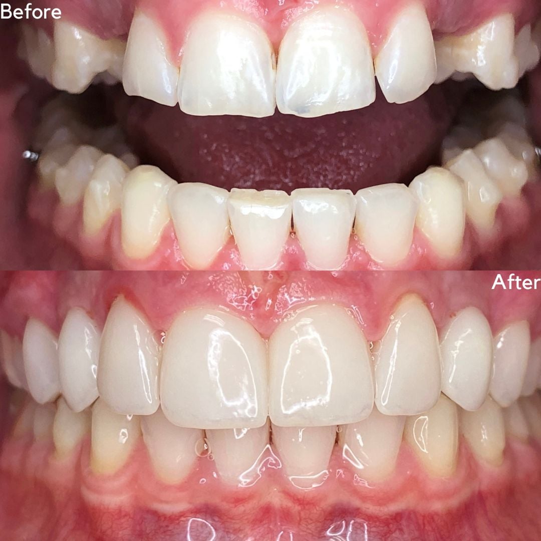 Cosmetic Dentistry Before and After