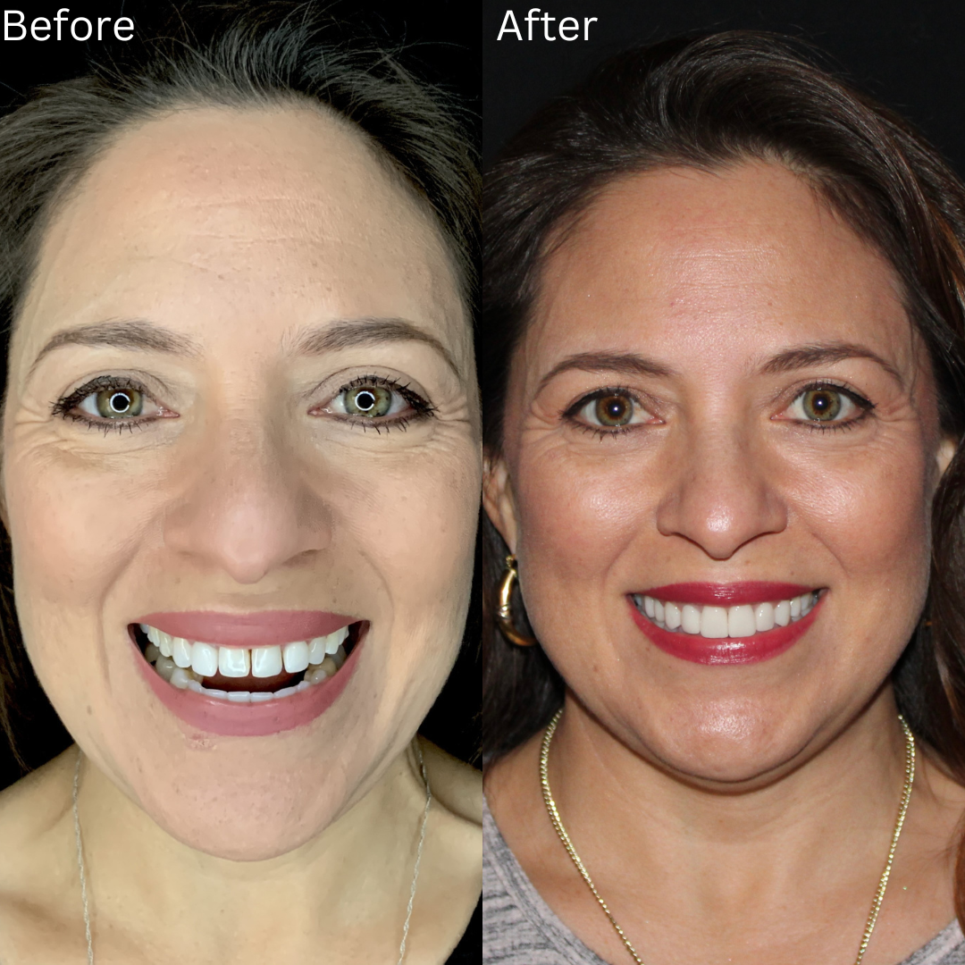 Porcelain Veneers Before And After