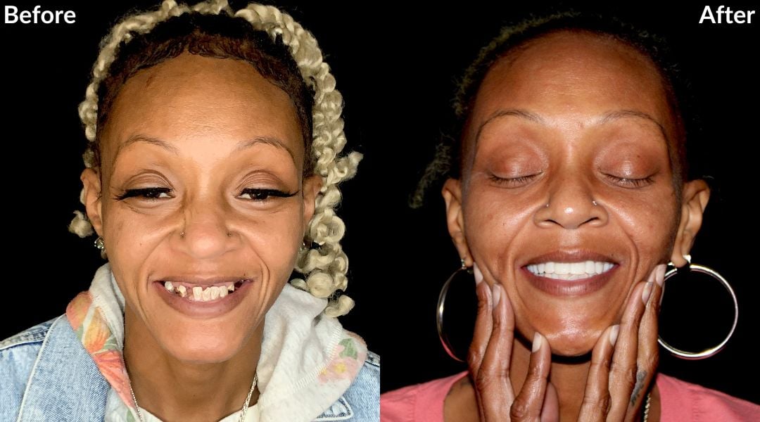 Treatments I have missing teeth