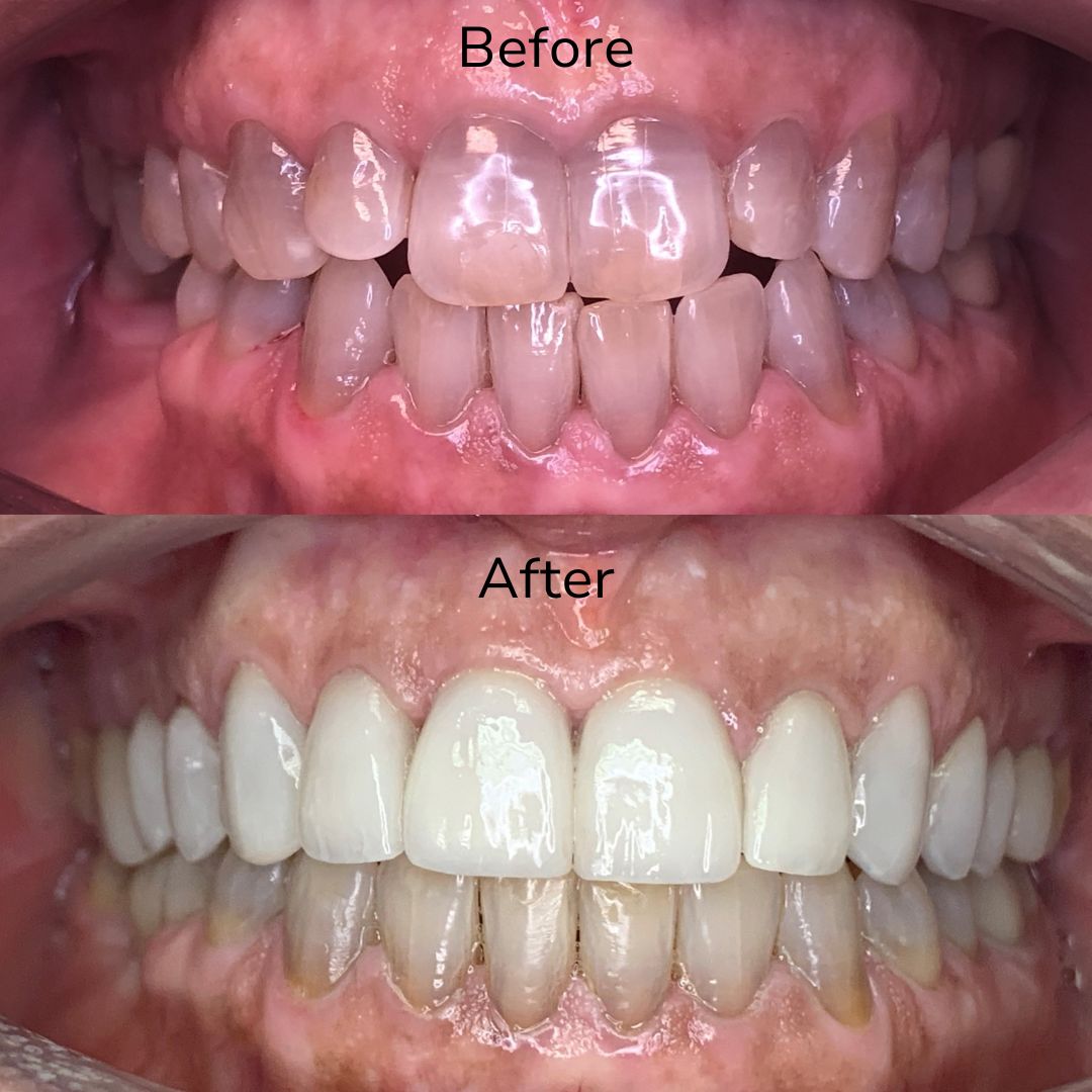 Porcelain Veneers Maria's smile transformation with Veneers