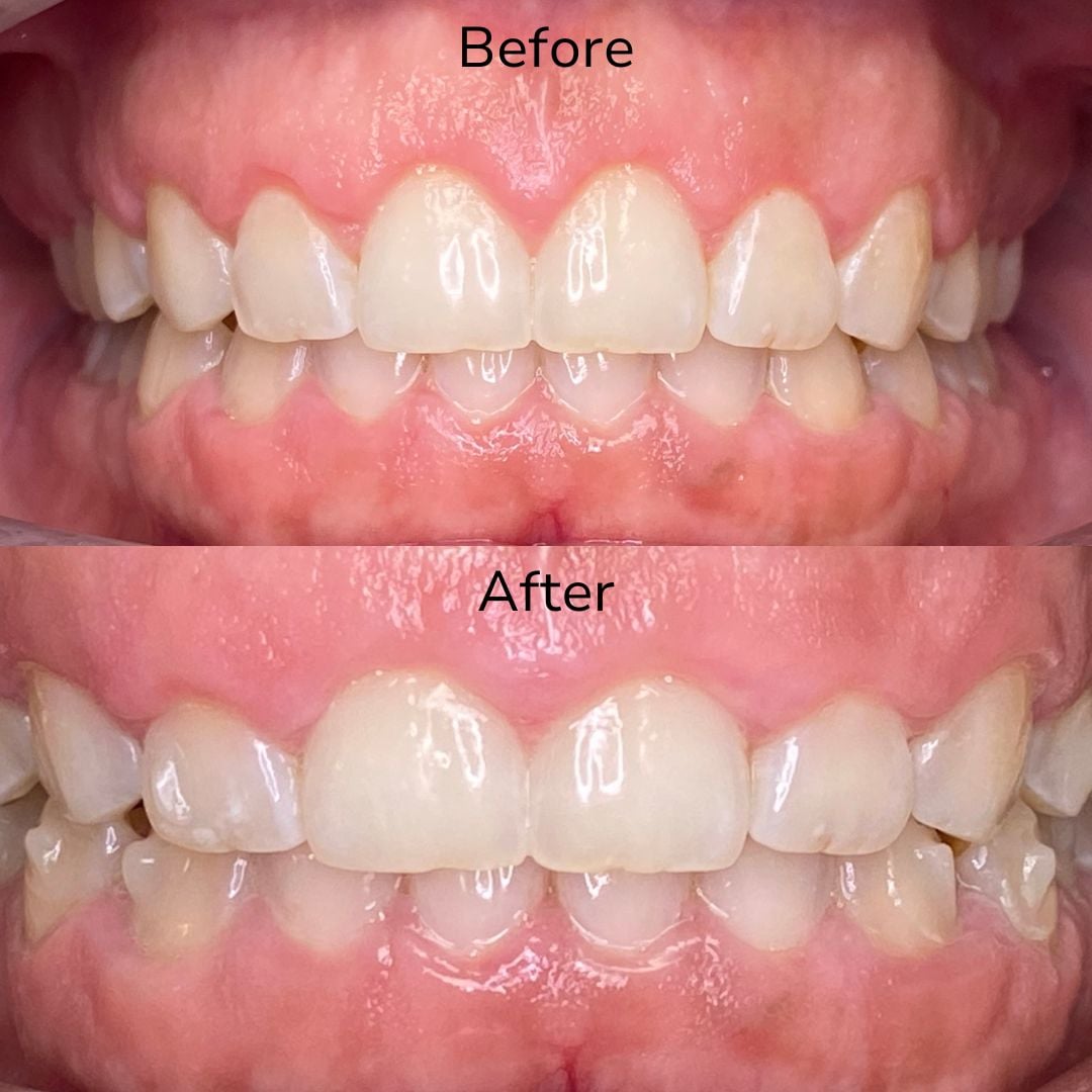 Cosmetic Dentistry Transforming Our Gummy Smiles