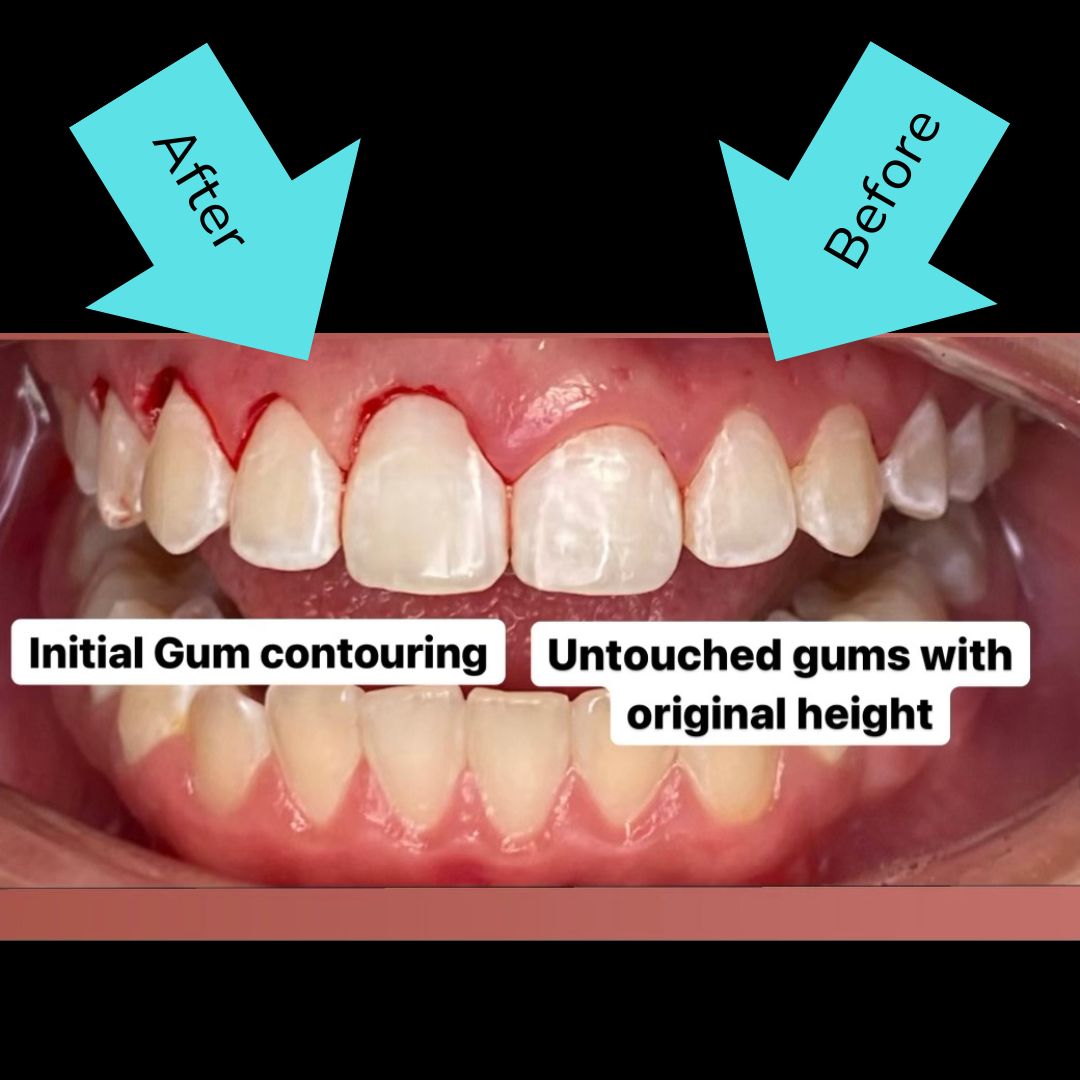 Cosmetic Dentistry Gummy smiles treatment