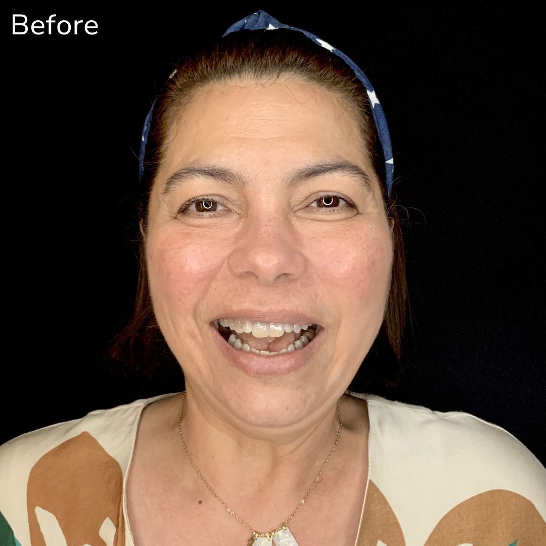 Porcelain Veneers Maria's smile transformation with Veneers