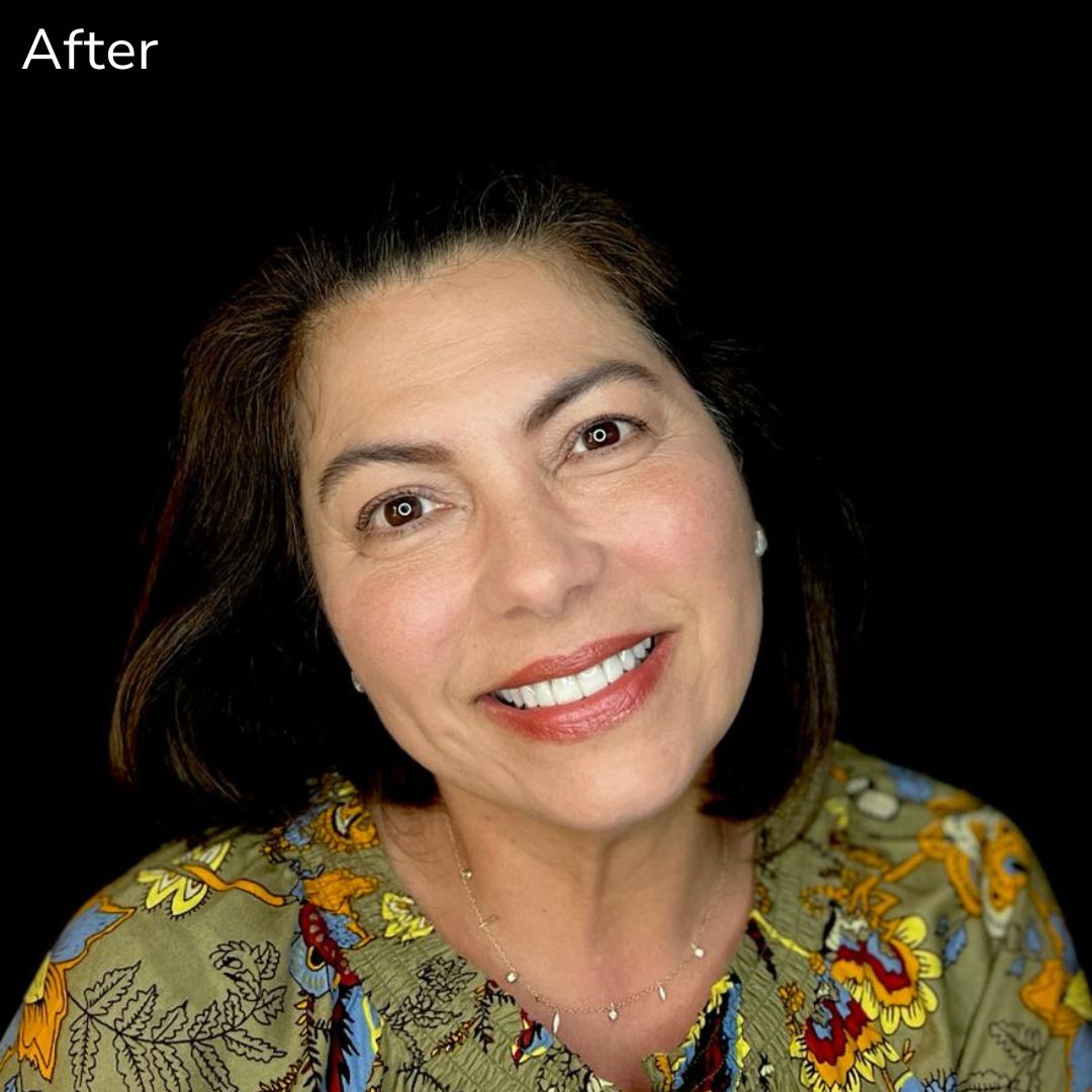 Porcelain Veneers Maria's smile transformation with Veneers