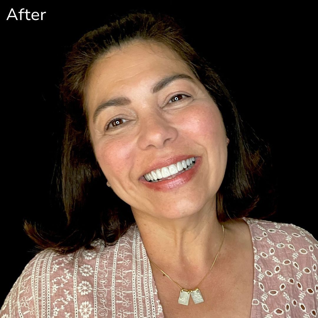Porcelain Veneers Maria's smile transformation with Veneers