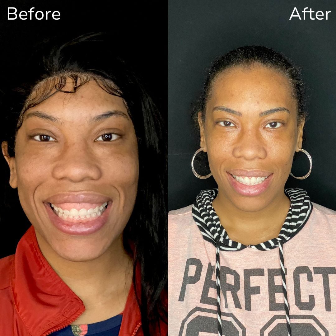 Cosmetic Dentistry Transforming Our Gummy Smiles