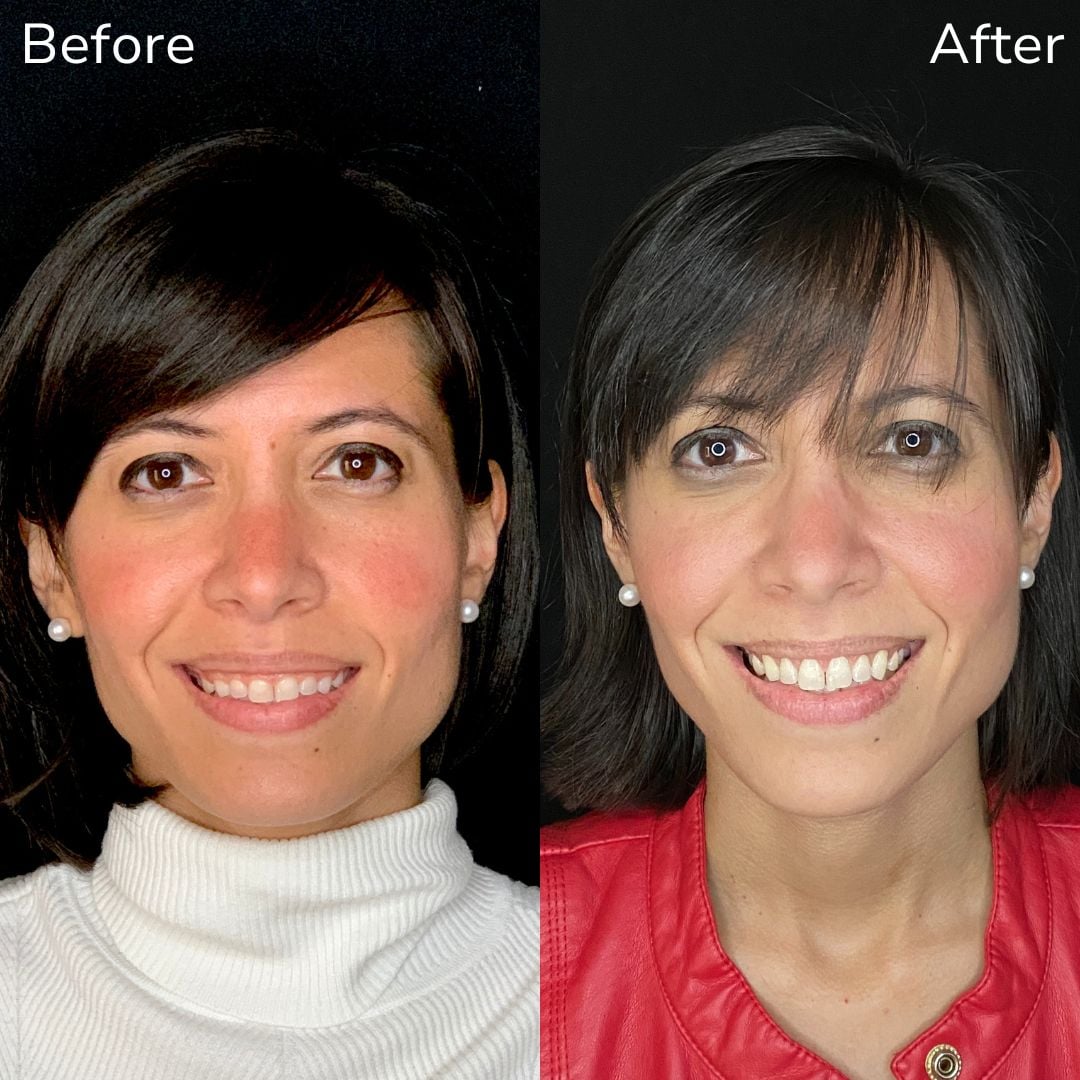 Cosmetic Dentistry Transforming Our Gummy Smiles