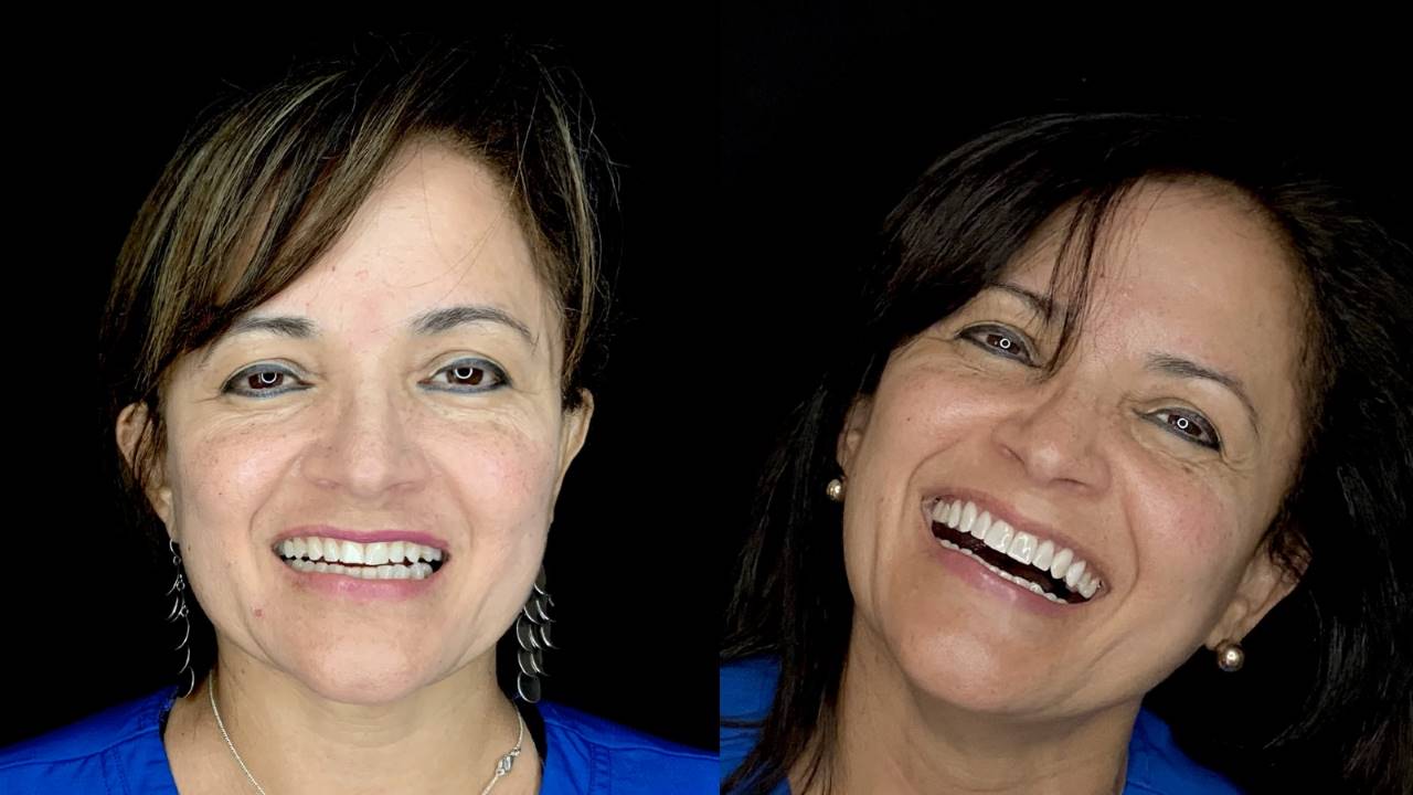 Porcelain Veneers Before & After Veneers