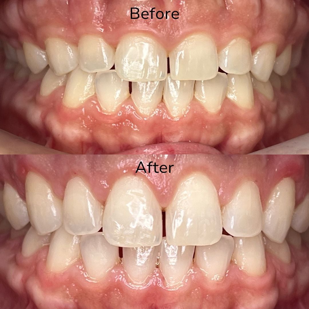 Cosmetic Dentistry Transforming Our Gummy Smiles