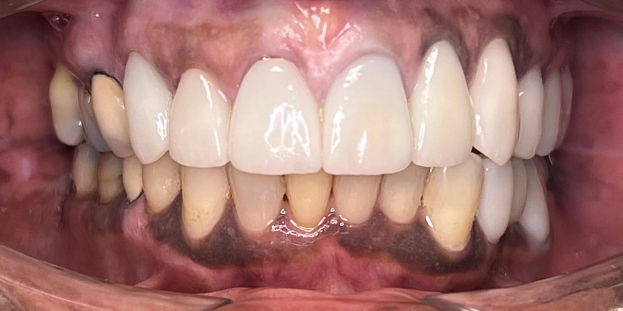 AFTER PORCELAIN CROWNS 