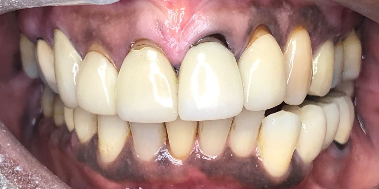 BEFORE PORCELAIN CROWNS 