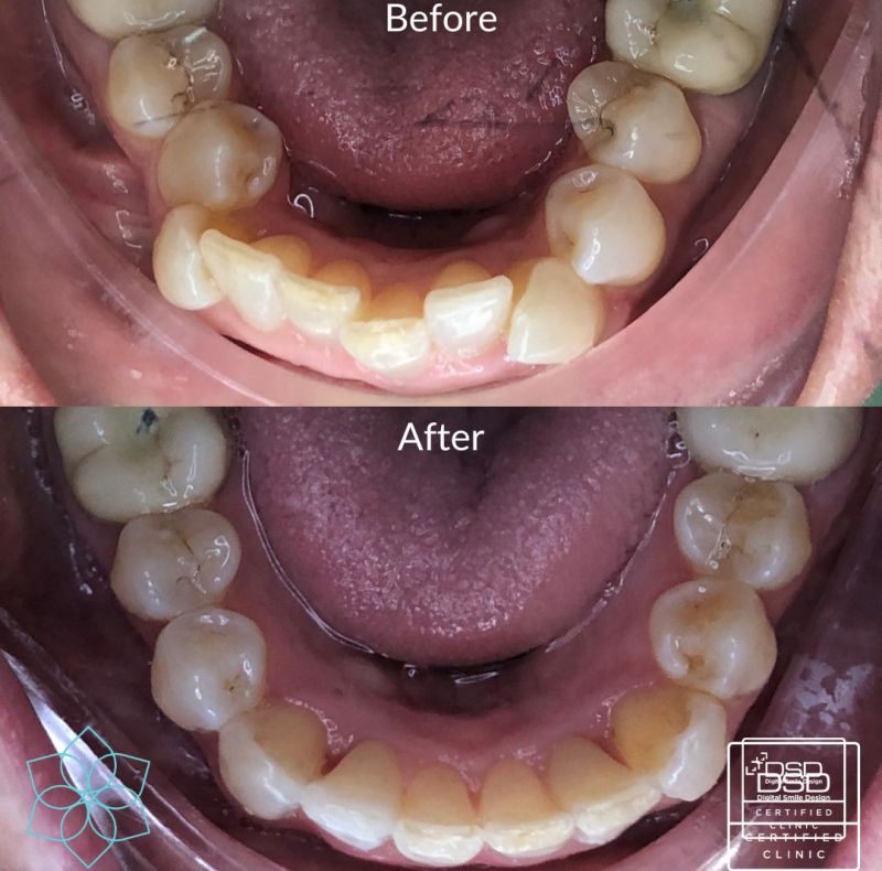 Invisalign Invisalign
