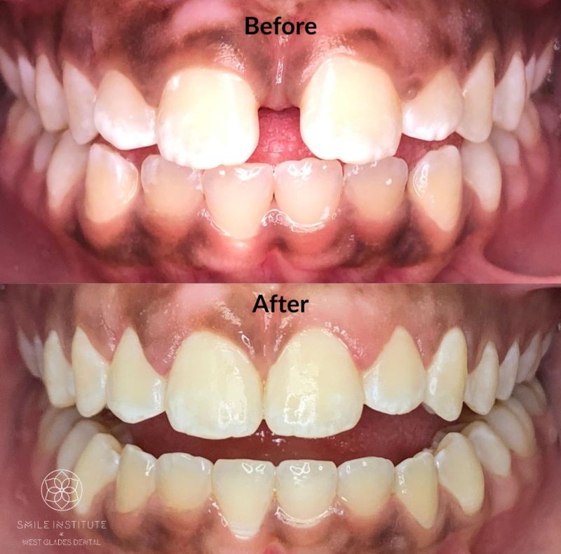 Invisalign Invisalign