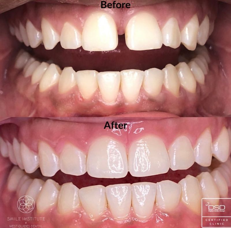 Invisalign Invisalign