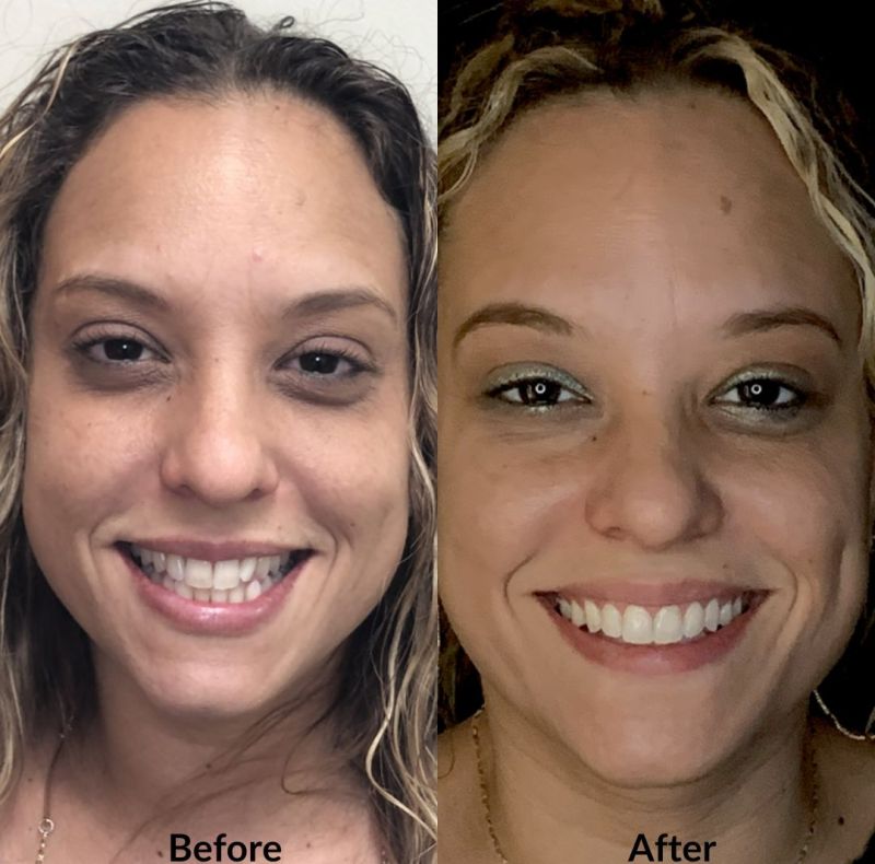 Invisalign Invisalign