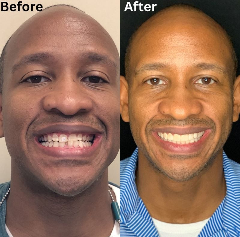 Cosmetic Dentistry Before And After Composite Veneers Treatment
