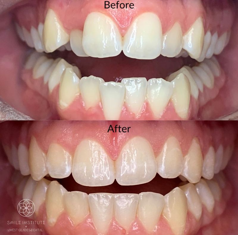 Invisalign Invisalign
