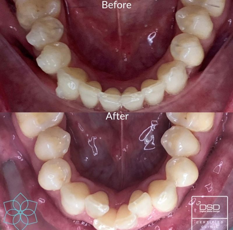 Invisalign Invisalign